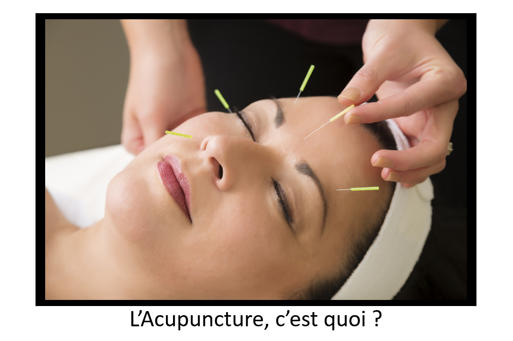 L'Acupuncture, c'est quoi ?